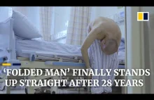 ‘Folded man’ stands up straight after 28 years