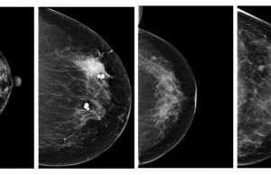 Algorytm sztucznej inteligencji równie dobrze wykrywa raka piersi jak radiolodzy
