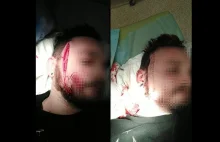 Atak po manifestacji w Gdyni. "Wyciągnął nóż i rozciął mi twarz"