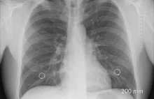 Walcz z zapaleniem płuc – chorobą dziadków i wnuków