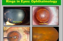 Rings in Eyes (Ophthalmology): Cholesterol, Blue, & More | Health Kura