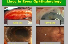 Lines in Eyes (Ophthalmology): Arlt, Vogt, Haab’s Striae, & All | Health...