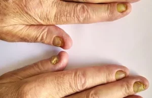 To nie grzybica – rzecz o żółtych paznokciach
