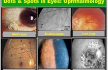 Dots in Eyes & Spots in Eyes (Ophthalmology) | Health Kura
