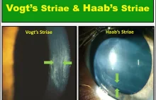 Vogt’s Striae and Haab’s Striae in Cornea | Health Kura