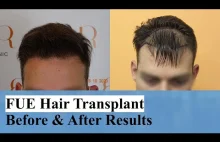 Przeszczep włosów. Zdjęcia od dnia zabiegu (2013) do dzisiaj