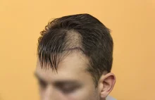 Klinika BHR - przeszczep włosów. Rezultaty po 7 latach!