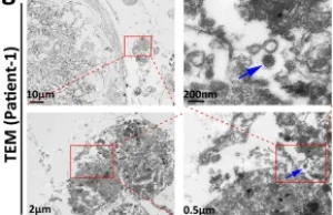 Nature: Biopsje post-COVID: wirus atakuje męskie jądra i szkodzi spermatogenezie