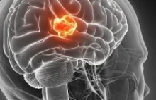 Glejak, niebezpieczny nowotwór mózgu, może rozwijać się podczas procesu leczenia