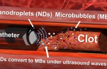 „Wiertło” i nanokropelki radzą sobie z upartymi zakrzepami