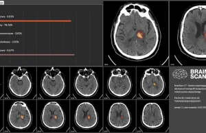 Polski start-up zwiększy skuteczność tomografii komputerowej mózgu