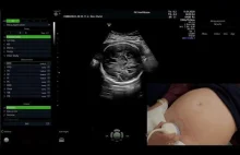 Badanie USG w III trymestrze ciąży - zobaczcie jakie detale widać