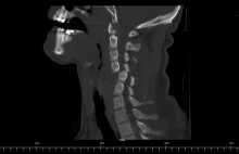 Tetraplegia - paraliż czterokończynowy.