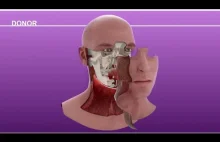 Animacja ukazująca proces transplantacji twarzy