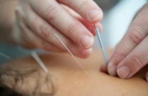 Jak działa akupunktura? I czy w ogóle działa?