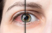 Czerwone oczy po marihuanie — jak marihuana może pomóc na jaskrę?