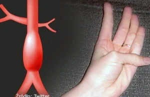 „Test kciuka” pomoże rozpoznać śmiertelną chorobę serca
