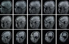 COVID-19 może powodować ubytek istoty szarej w mózgu
