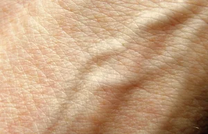 Google stworzyło aplikację, która może rozpoznać 288 chorób skóry