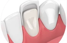 Licówki | B-Dental - gabinet dentystyczny - stomatologia