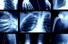 AI do analizy zdjęć rentgenowskich nauczyły się rozpoznawać rasę pacjenta
