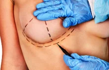 Wykazano, że implanty piersi są niebezpieczne, naukowcy chcą zakazu...