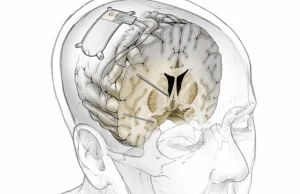 Implant mózgowy do leczenia depresji w czasie rzeczywistym.