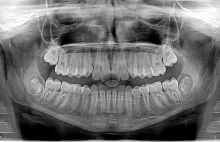 Zagadka zębów mądrości rozwiązana. Dlaczego pojawiają się tak późno?