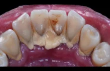 37yo. Female. SCALING - TARTAR - CALCULUS | Dentist | Dokter Gigi Tri Putra