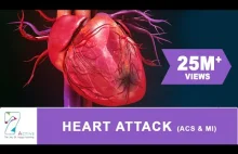 Jak wygląda i co to jest atak serca oraz ostry zespół wieńcowy
