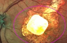Przełom w medycynie: Innowacyjny implant przywraca wzrok