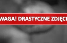 [DRASTYCZNE] Oderwana noga w wyniku ostrzału