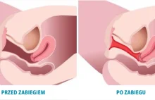 Zespół rozluźnienia pochwy - przyczyny i leczenie luźnej pochwy