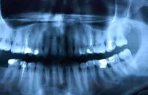 Trzeci komplet zębów zamiast tradycyjnych implantów