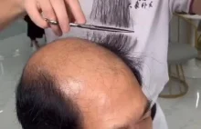 Chiński sposób na łysinę.