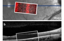 Przełomowa technika do diagnostyki chorób oczu