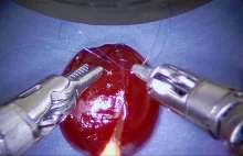 Robot chirurgiczny Da Vinci w akcji
