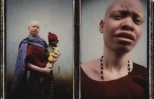 Afryka nie akceptuje "fałszywego białego człowieka". Polowanie na albinosów