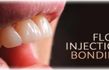 Flow injection bonding | B-Dental - gabinet dentystyczny - stomatologia