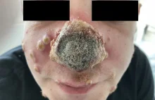 Gnijący nos u 40-latka. Komplikacje w związku z małpią ospą