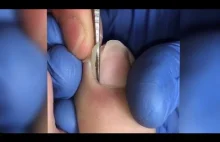 Usuwanie wrastającego paznokcia przy pomocy ostrza
