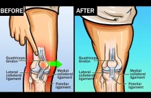 Co zrobić w przypadku skręcenia kolana? Napraw Skręcone kolano!
