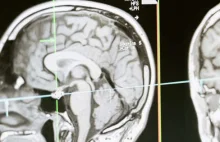 Ta witamina chroni mózg przed demencją! Naukowcy mają dowody