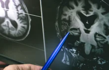 Naukowcy zbadali mózgi zmarłych na COVID-19. Zobaczyli "przerażające" zmiany