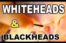 WHITEHEADS AND BLACKHEADS IN EARS !!! ( - All pimples channel