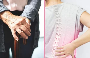 Osteoporoza - pierwsze objawy i rozpoznanie