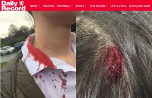 14-letni uczeń zaatakowany kastetem w szkole za swoje polskie pochodzenie