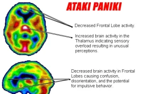 Ataki paniki, niepokój, związany z niskim poziomem witaminy B i żelaza