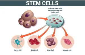 Przeszczep komórek macierzystych zatrzymuje postęp stwardnienia rozsianego