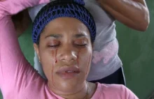 Kobieta płacze "krwawymi łzami". Lekarze są bezradni